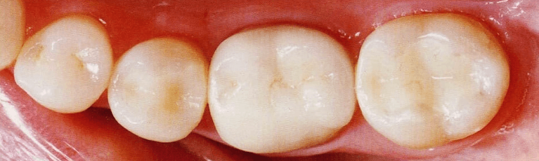 Composite-Fillings-After-Image