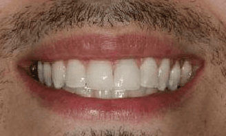 Crowns-Bridges-After-Image