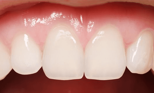 Dental-Bonding-After-Image