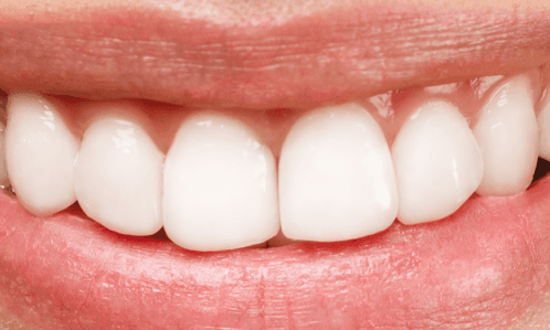 Teeth-Whitening-After-Image