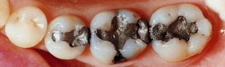 Composite-Fillings-Before-Image