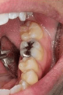 Cracked-Tooth-Repair-Before-Image