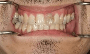 Crowns-Bridges-Before-Image
