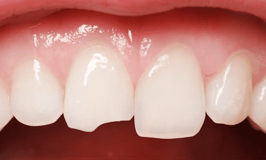 Dental-Bonding-Before-Image
