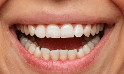 Porcelain-Veneers-Before-Image