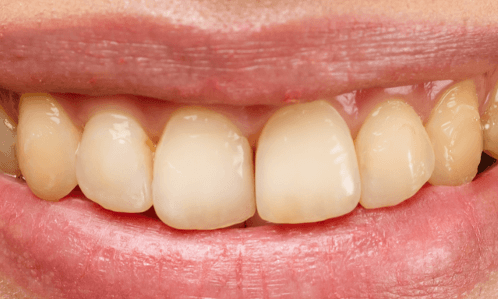Teeth-Whitening-Before-Image